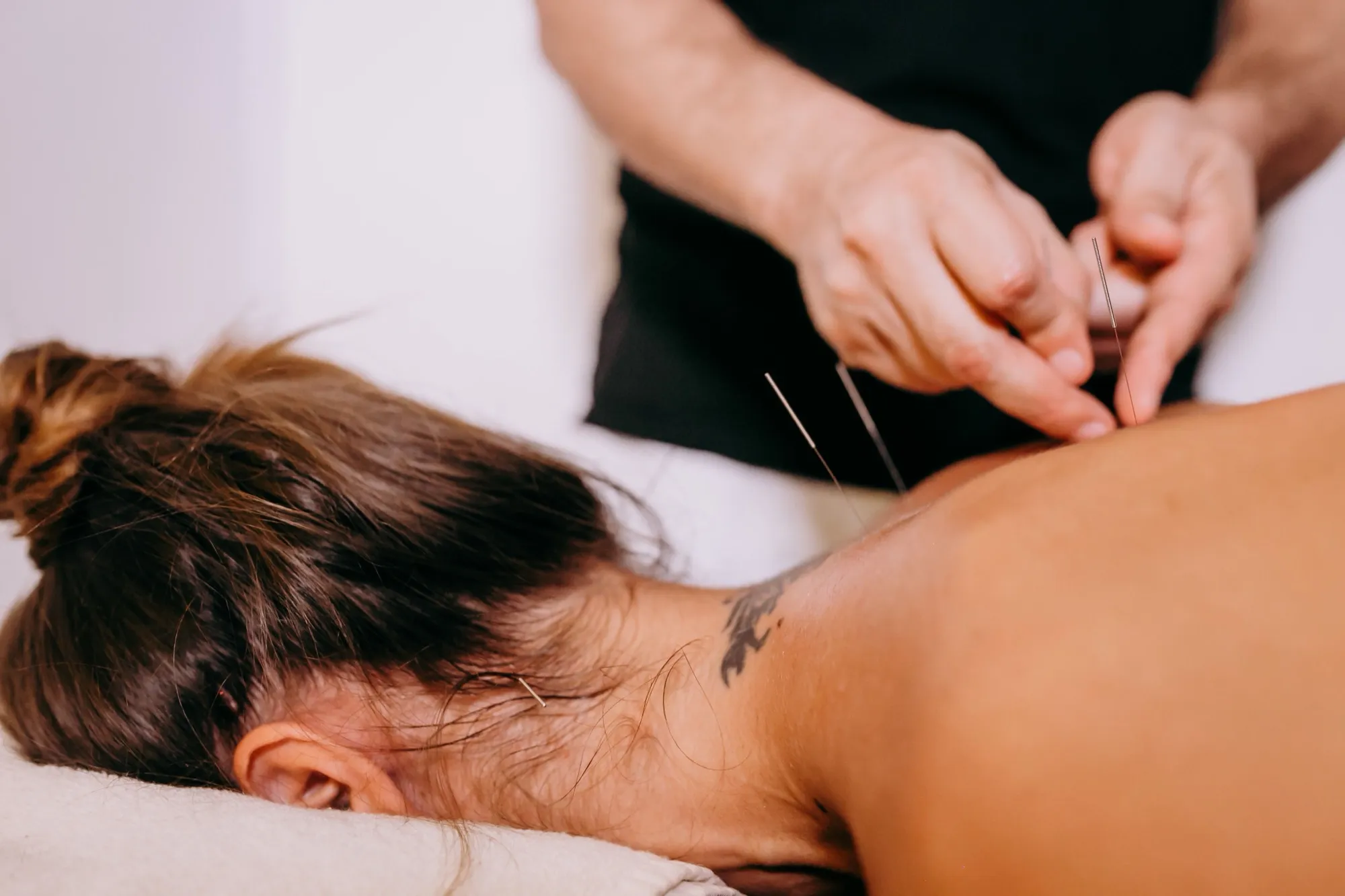 Clinical dry needling
